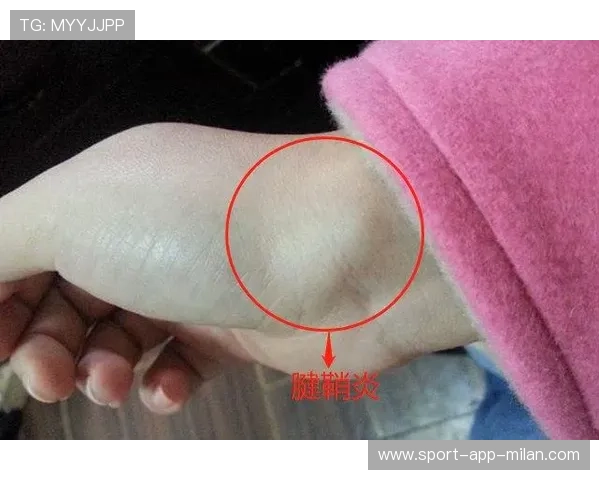 电竞选手的“腱鞘炎”:手腕劳损的职业病 电竞选手的“腱鞘炎”:手腕劳损的职业病